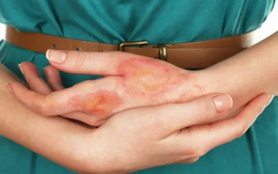 Common Causes of Burn Injuries
