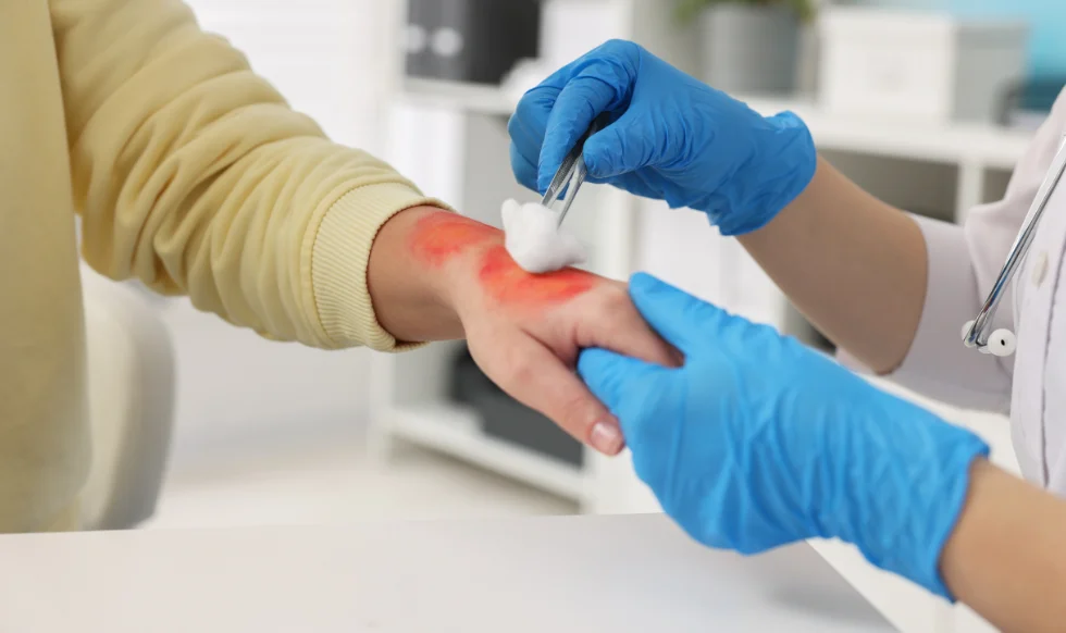 Medical professional treating a burn injury on a patient's hand using cotton and antiseptic