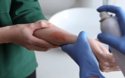 Types of Burn Injuries and Their Legal Implications