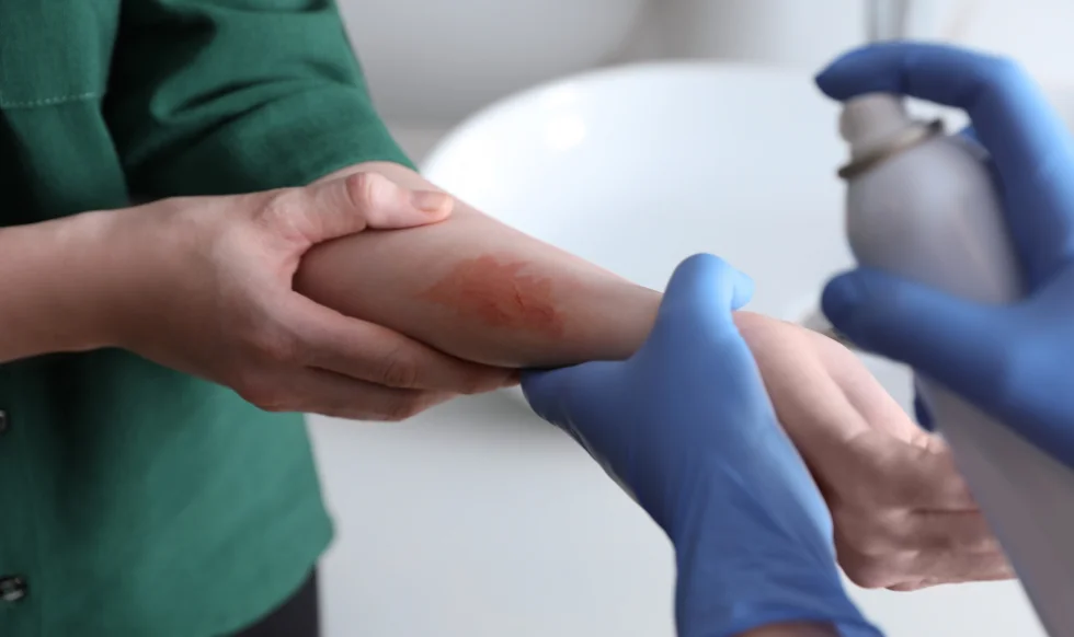 A medical professional applies spray treatment to a burn injury on a person’s forearm.